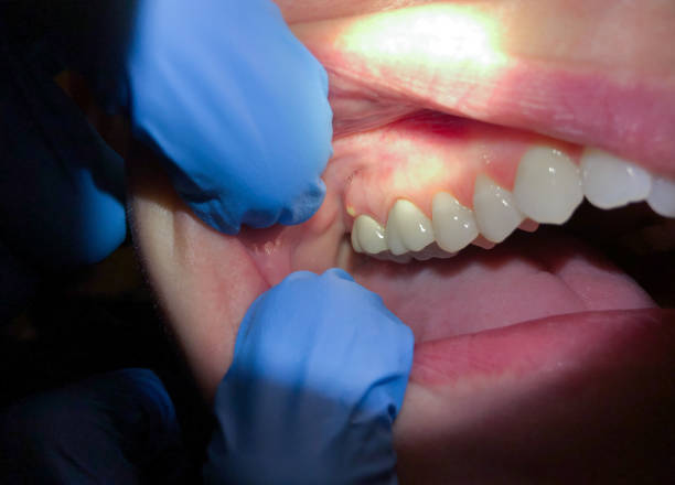 Best Emergency Dental Extractions in Robert Lee, TX